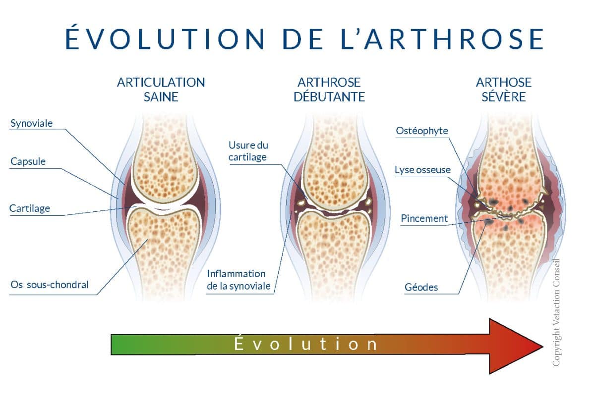 Evolution de l'arthrose